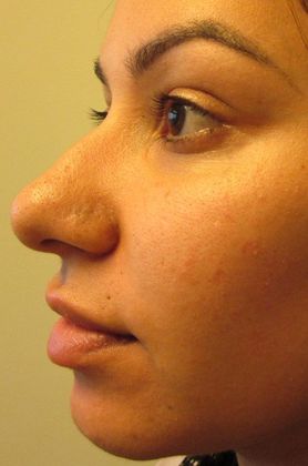 Rhinoplasty: Case 13 - Rhinoplasty, Septoplasty, Milford, CT - Before