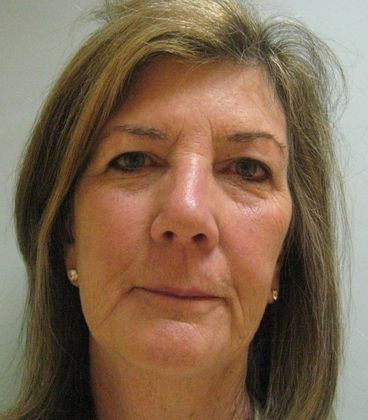 Facelift: Case 3 - Facelift, Darien - Before