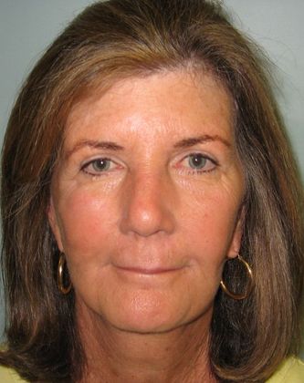 Facelift: Case 3 - Facelift, Darien - After