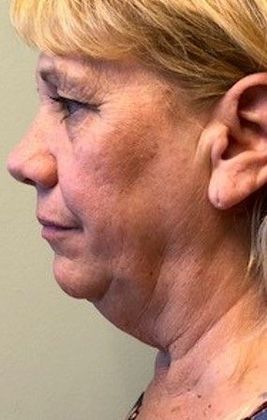 Facelift: Case 18 - Face, Necklift, Shelton - Before