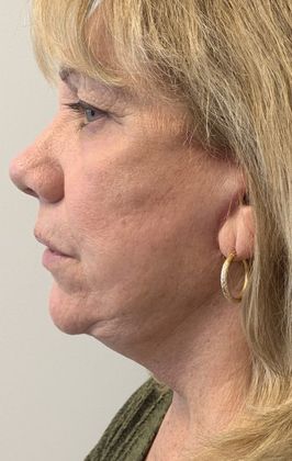 Facelift: Case 18 - Face, Necklift, Shelton - After