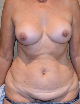 Mommy Makeover Case 125 - Before