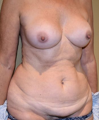 Mommy Makeover: Case 125 - Before