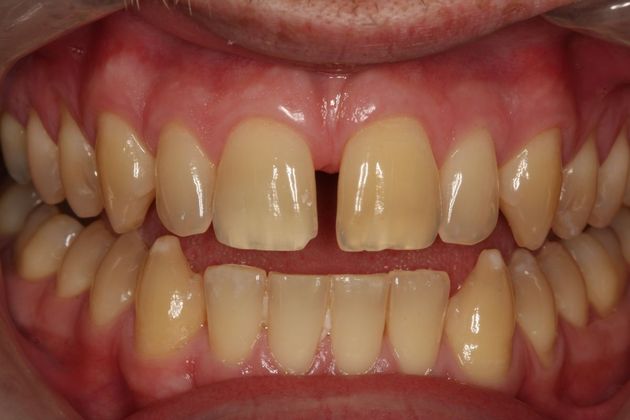 Porcelain Veneers: Case 16 - Before