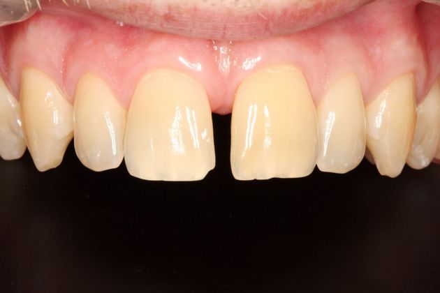 Porcelain Veneers: Case 16 - Before
