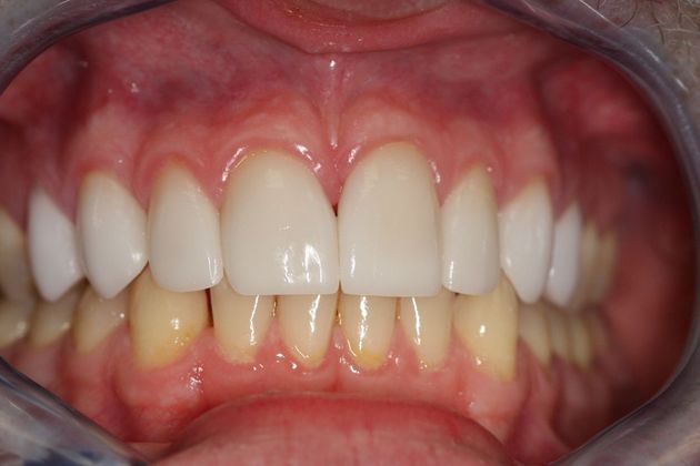 Porcelain Veneers: Case 16 - After
