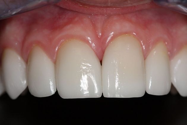 Porcelain Veneers: Case 16 - After