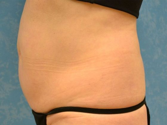 Liposuction: Case 1528- Sylvania, OH - Before