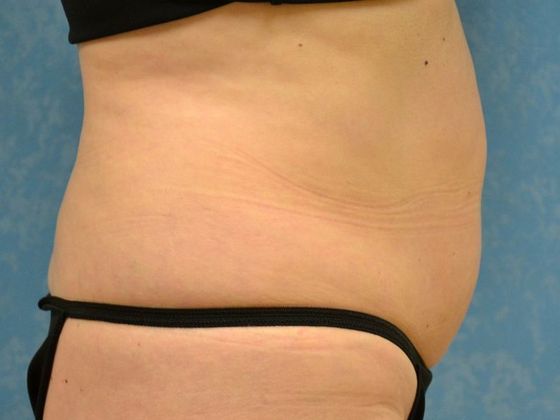 Liposuction: Case 1528- Sylvania, OH - Before