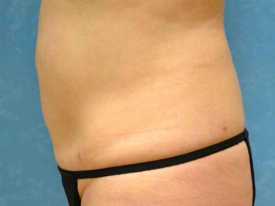 Liposuction: Case 1528- Sylvania, OH - After