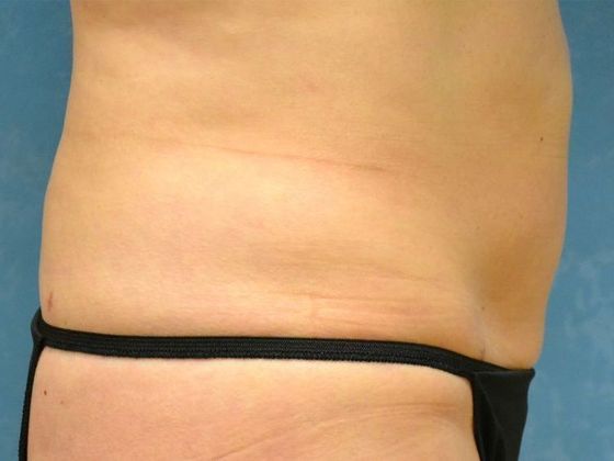 Liposuction: Case 1528- Sylvania, OH - After