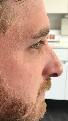 Rhinoplasty: Case 14 - Rhinoplasty, New Canaan - Before