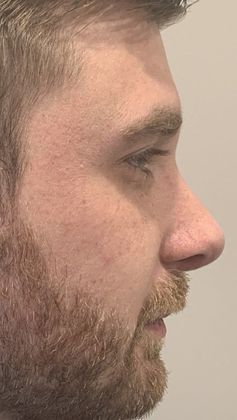 Rhinoplasty: Case 14 - Rhinoplasty, New Canaan - After