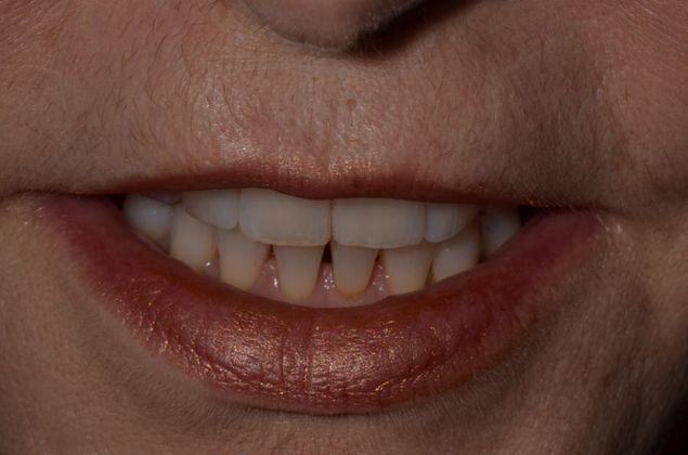 Porcelain Veneers: Case 17 - Before