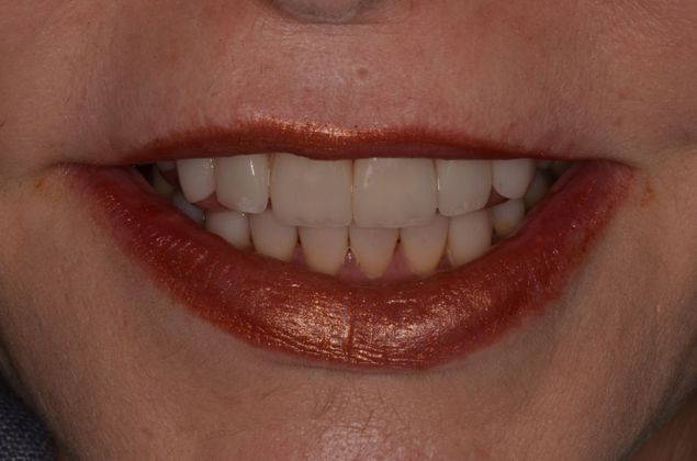 Porcelain Veneers: Case 17 - After