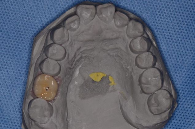 Dental Implants: Case 23 - Lab work