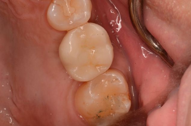Dental Implants: Case 23 - After