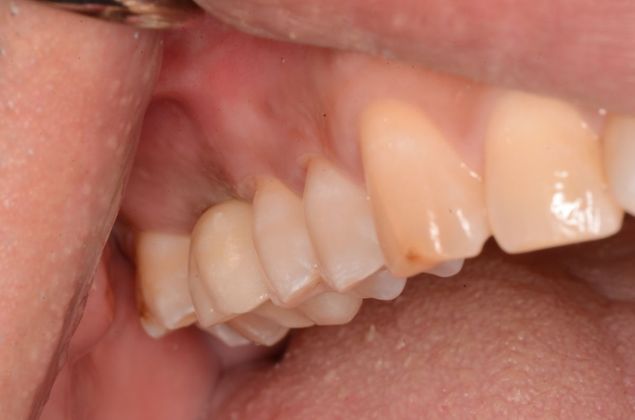 Dental Implants: Case 23 - After