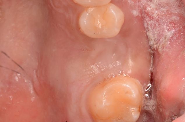 Dental Implants: Case 23 - Before