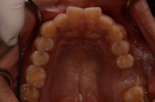 Dental Implants: Case 23 - Before