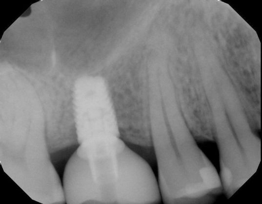 Dental Implants: Case 23 - After