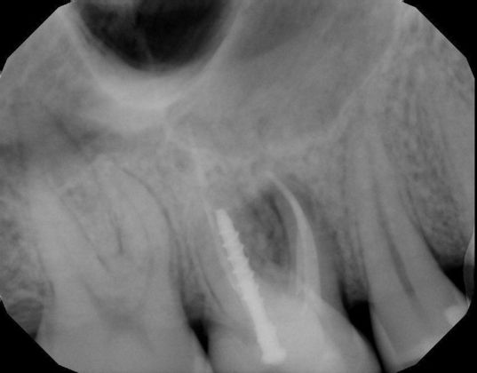 Dental Implants: Case 23 - Before