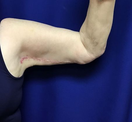 Arm Contouring / Lift: Case 6 (15116) - After