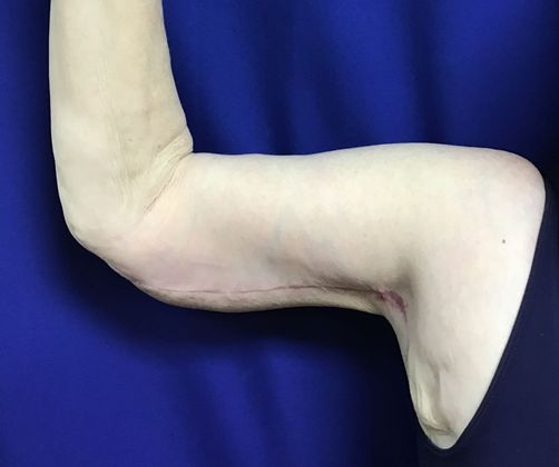 Arm Contouring / Lift: Case 6 (15116) - After