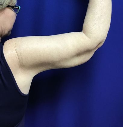 Arm Contouring / Lift: Case 6 (15116) - After