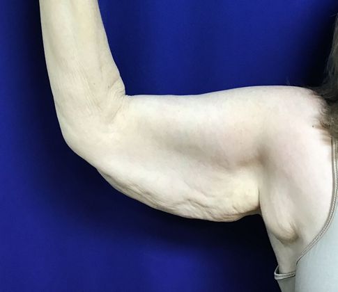 Arm Contouring / Lift: Case 6 (15116) - Before