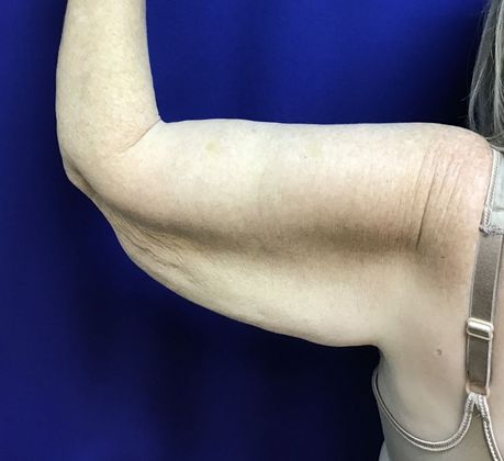 Arm Contouring / Lift: Case 6 (15116) - Before