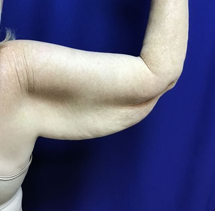 Arm Contouring / Lift: Case 6 (15116) - Before