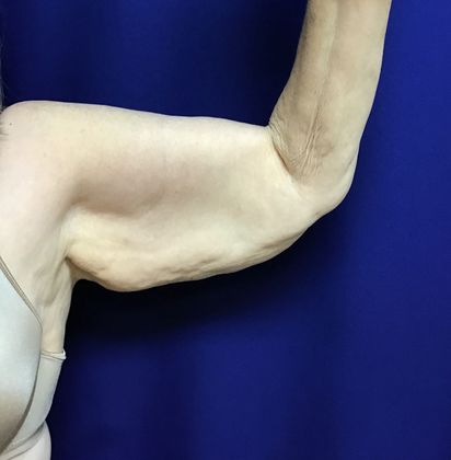Arm Contouring / Lift: Case 6 (15116) - Before