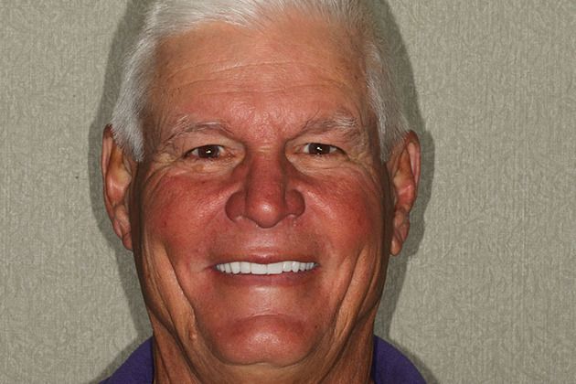 Dental Implants Cases