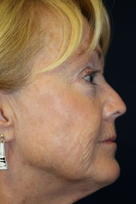 CO2 Laser Resurfacing: Case 1 - Before