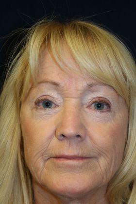 CO2 Laser Resurfacing: Case 1 - Before