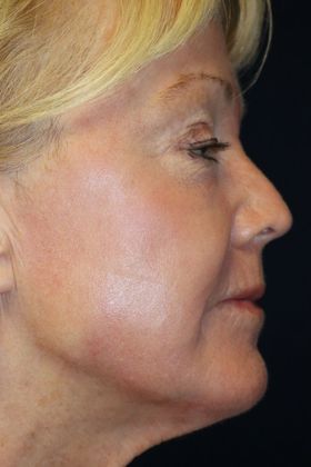 CO2 Laser Resurfacing: Case 1 - After