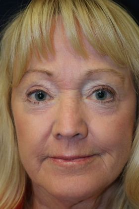 CO2 Laser Resurfacing: Case 1 - After