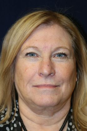 CO2 Laser Resurfacing: Case 2 - Before