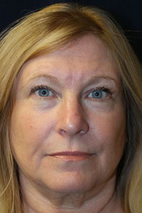 CO2 Laser Resurfacing: Case 2 - After