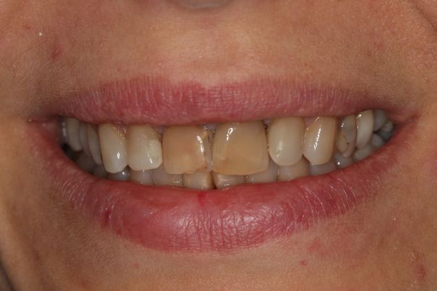 Porcelain Veneers: Case 18 - Before