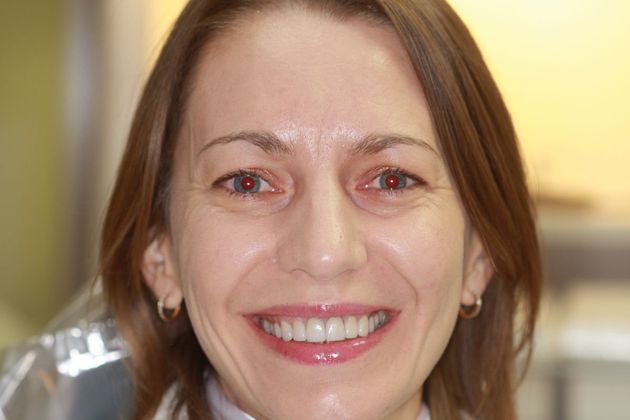 Porcelain Veneers: Case 18 - After