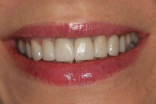 Porcelain Veneers: Case 18 - After