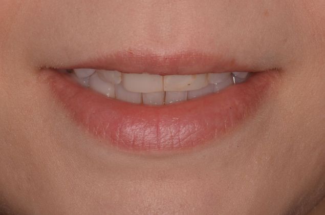 Porcelain Veneers: Case 19 - Before