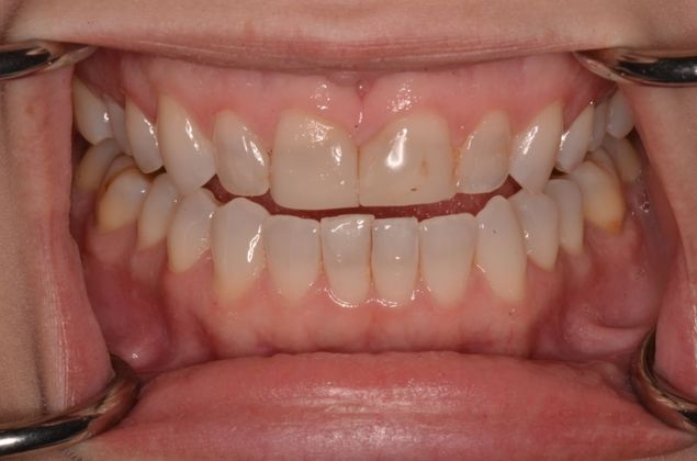 Porcelain Veneers: Case 19 - Before
