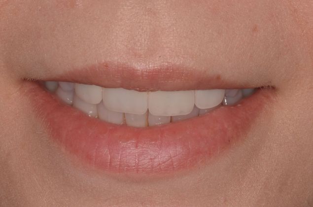Porcelain Veneers: Case 19 - After