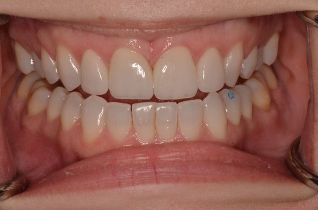 Porcelain Veneers: Case 19 - After