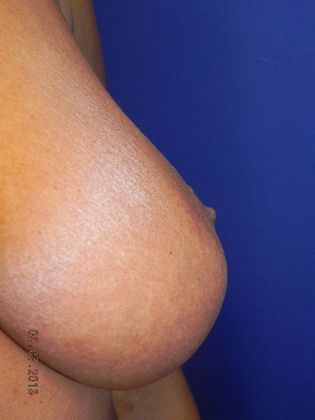 Breast Nipple & Areola : Case 7 (17292) - Before