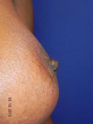 Breast Nipple & Areola : Case 7 (17292) - After