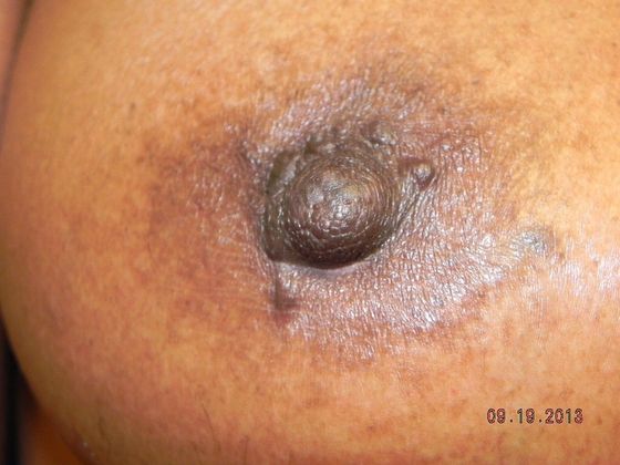 Breast Nipple & Areola : Case 7 (17292) - After